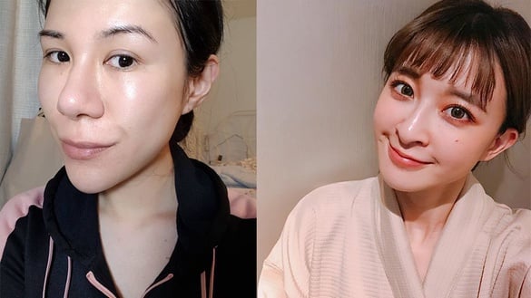 除痘痘粉刺「神水」推薦！鄉民默默大推好物拯救爛臉