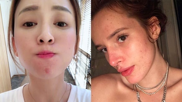 內分泌失調，等於天天爆生理痘！25歲後痘痘仍爆長，快檢查是不是「婦科痘」！