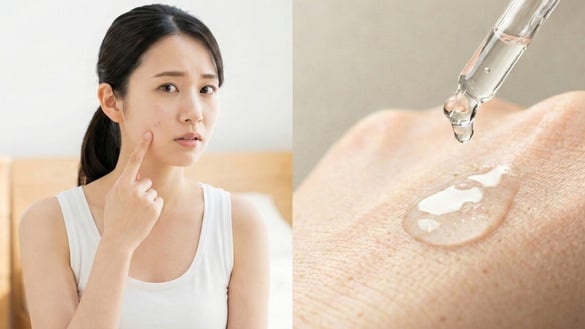 痘痘怎麼消？抗痘精華推薦指南：快速消痘、淡化痘印一次看懂！