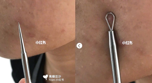 清粉刺必備工具解析！一次了解粉刺夾、粉刺針和粉刺棒差異，讓「開放性與閉鎖性粉刺」通通慢走不送～