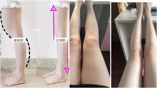 腿粗還分「脂肪型、水腫型」？不同腿搭配不同運動，1周速成腿精～