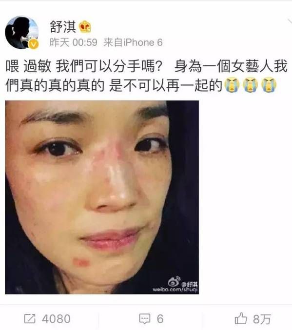 舒淇po過敏素顏照求救～特搜「敏感肌界」默默很紅的口碑乳霜