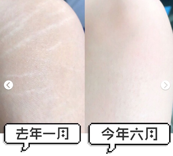 剷肉25公斤零肥胖紋的3大關鍵！網推去除肥胖紋的神油、乳霜是這些