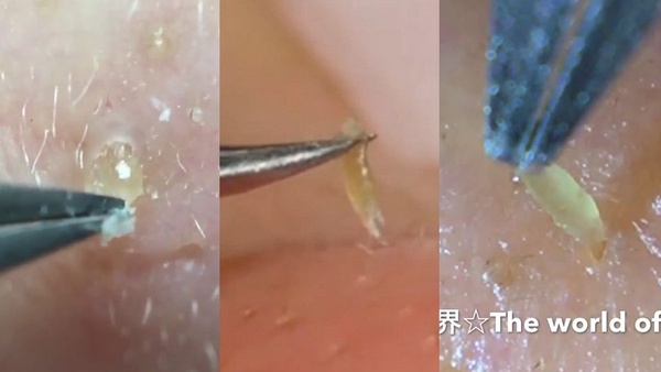粉刺控最身心舒暢的三大瞬間！同場加映：美容師、粉刺重症者激推「根除粉刺」神品