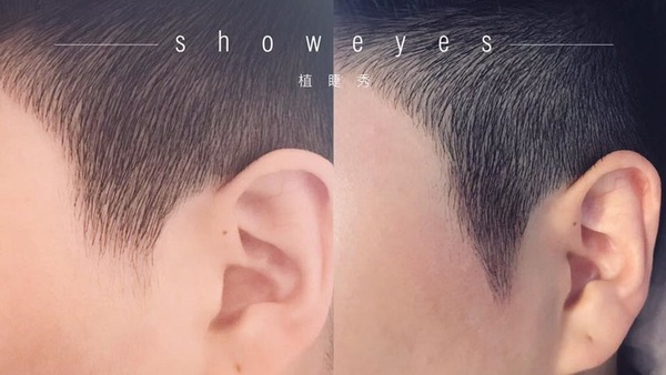 禿髮女孩必學「髮量激增6招」，髮際線前進，豐厚秀髮更好造型！