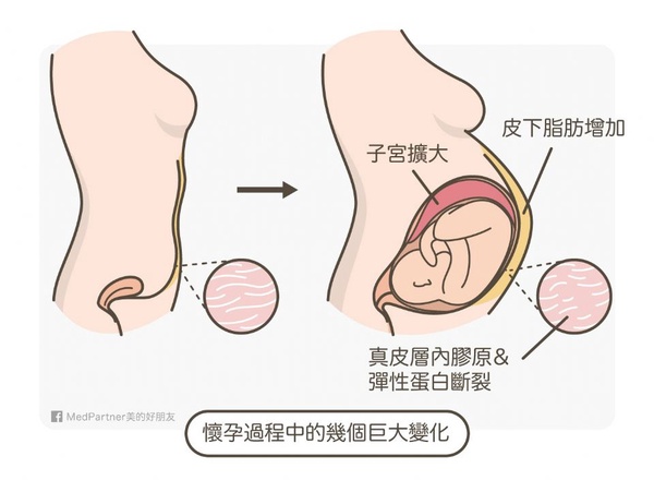 HOLD住姐曬八月大孕肚！被狂噴妊娠紋嚇到，笑說是甜蜜的煩惱！
