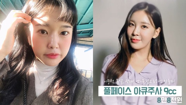 韓妞的肌膚管理祕訣公開！立即有感水光針、韓式拉提，修復期還超短！