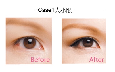 『膠帶眼整型』，立馬雙眼亮晶晶