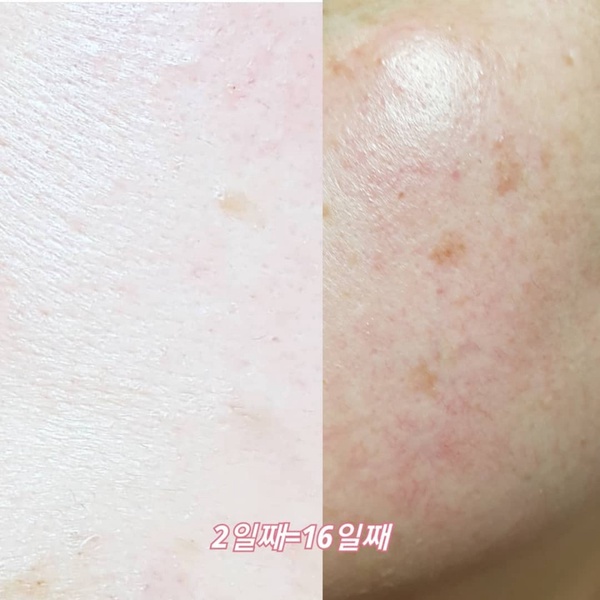 戴口罩突爆痘、臉血絲明顯？皮膚科醫師：改變保養方式，才能預防「口罩過敏、口罩痘」