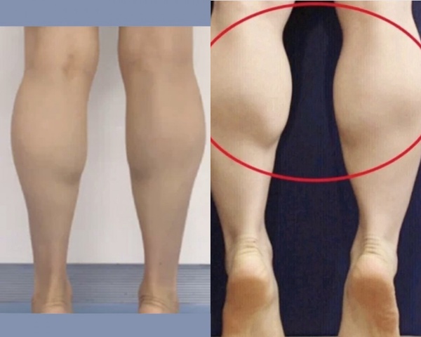 小腿粗壯分3大類！健身教練不同腿型「瘦小腿運動」，做對小腿外翻、小腿肌立消
