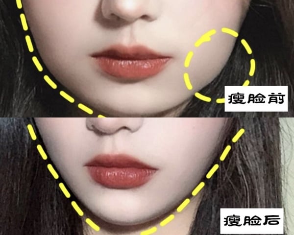咬肌型臉