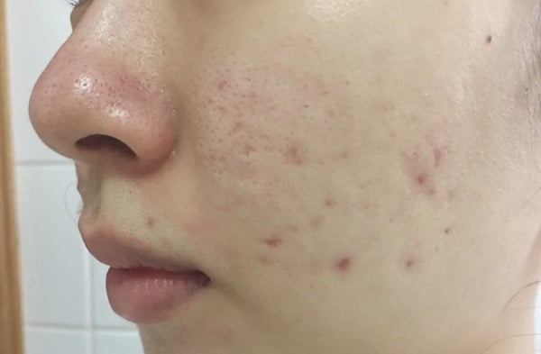 彩妝師瑕疵肌「無瑕輕薄底妝」畫法！脫皮/痘痘/毛孔都有解，新手底妝步驟這樣做