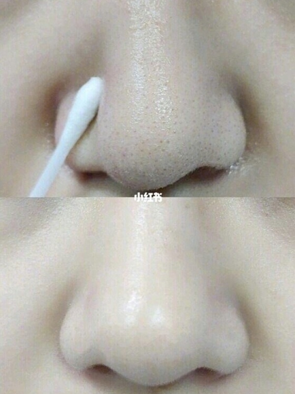凡士林用途1:掰掰黑頭粉刺