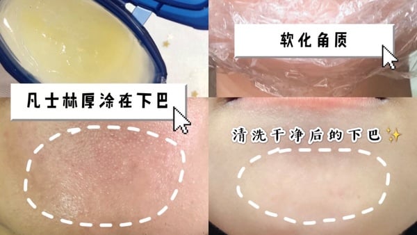 下巴粉刺、痘痘退散！10招消滅下巴粉刺方法，這樣敷泥膜&刷酸，下巴顆粒全消失