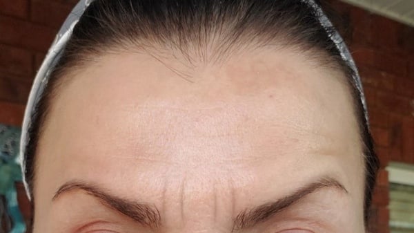 抬頭紋主要分為三種類型:2. 垂直型抬頭紋