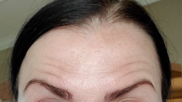 抬頭紋主要分為三種類型:3. 對稱型抬頭紋