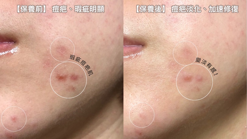 寶可夢迷必收！理膚寶水B5萬用霜X寶可夢聯名，一支收服乾燥脫屑、痘疤瑕疵、敏感泛紅!