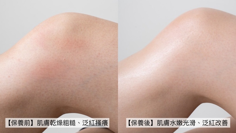 換季必備颶風級乾癢救星！2024最強成分「B3菸鹼醯胺」激發7倍保濕力，乾繃紅癢都有解