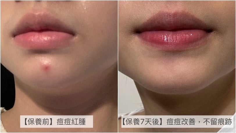 斷崖式分手痘痘！貝膚黛瑪「3D水楊酸」調理皮脂關鍵，養成粉刺痘痘絕緣體！