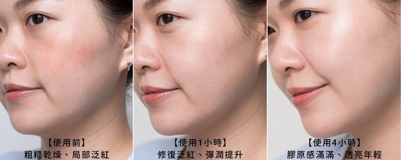 NEXT LEVEL玻尿酸新紀元!理膚寶水全新型態修復型玻尿酸醫美機轉3倍滲透淡化81%深層紋*