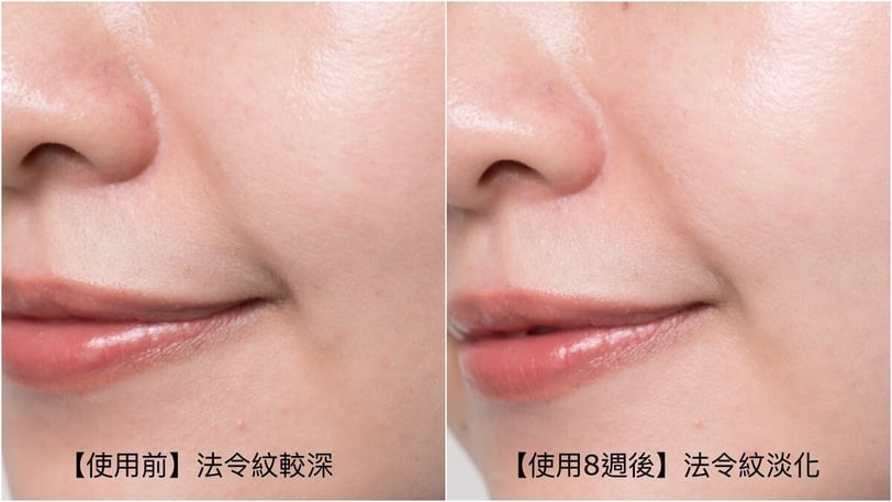 NEXT LEVEL玻尿酸新紀元!理膚寶水全新型態修復型玻尿酸醫美機轉3倍滲透淡化81%深層紋*