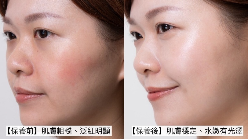 醫美術後保養怎麼做？敏感肌修護保濕雙11推薦55折入手放大醫美效果，不再砸錢無效保養