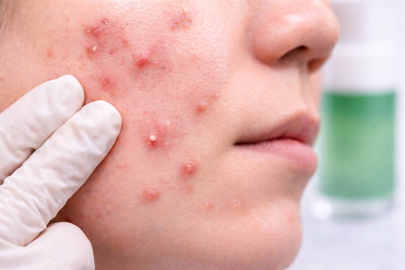 痘痘怎麼消？抗痘精華推薦指南：快速消痘、淡化痘印一次看懂！
