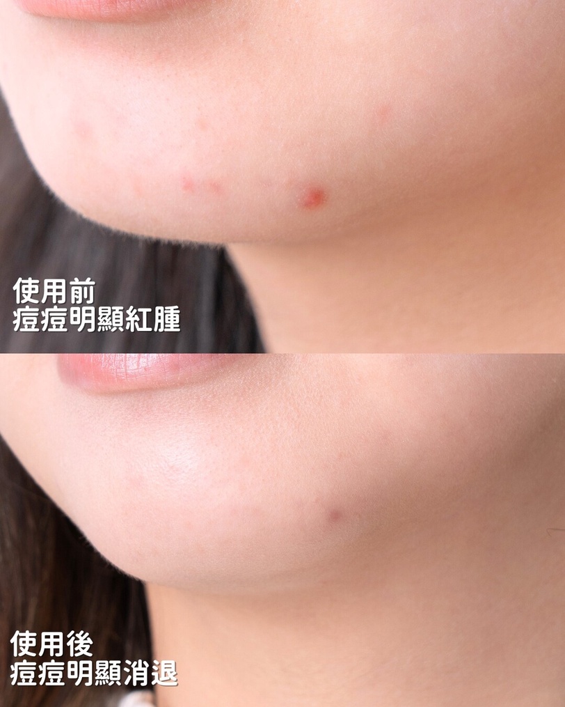 痘痘怎麼消？抗痘精華推薦指南：快速消痘、淡化痘印一次看懂！