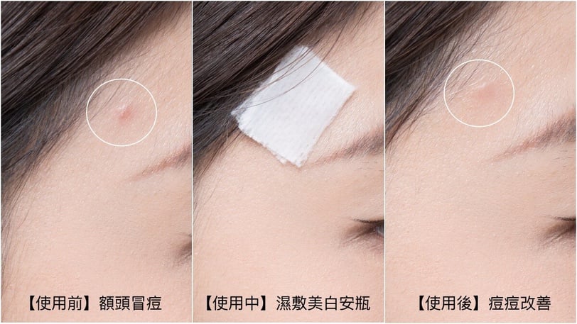 全網瘋傳「AI抗痘SOP」！擺脫痘痘粉刺危肌，歸零粗大毛孔，心動快來筆記