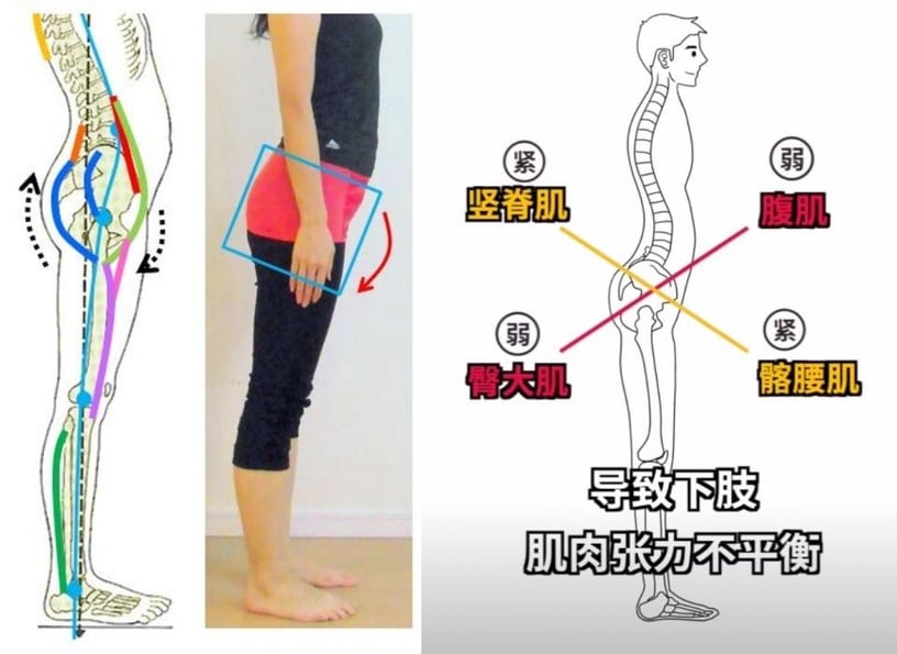 右滑圖片～了解、怎麼改善長時間坐姿所造成的「骨盆前傾」！