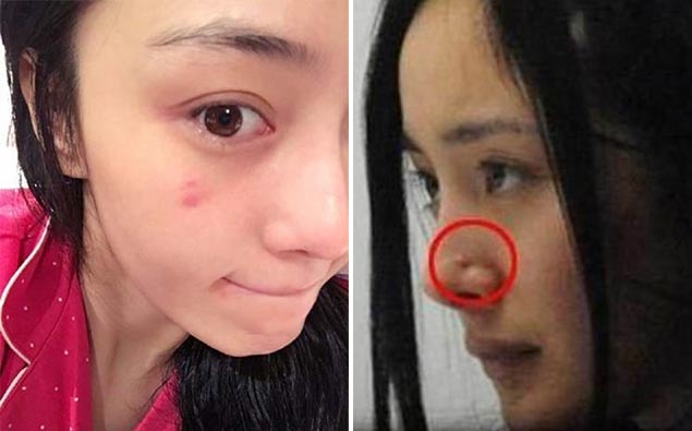 你永遠不懂油肌的傷悲!油肌與痘痘怎麼總是惡性循環...