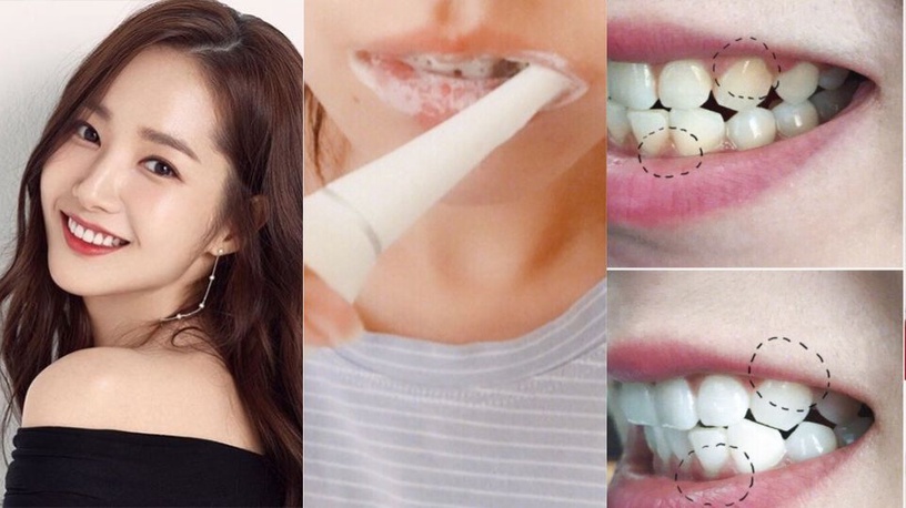 牙齒美白10天有感!超溫和居家牙齒美白,靠濕敷直接還你一口白牙