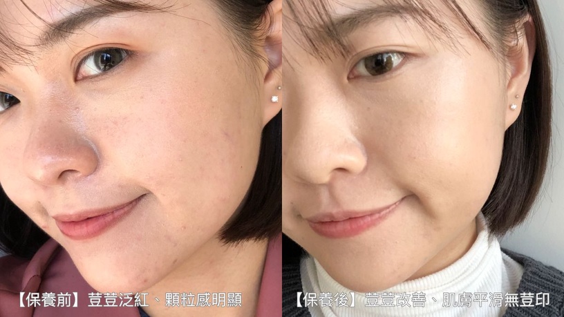 施巴 sebamed 最強痘淨CP 我的青春不荳留 滅荳神器 抗荳聰明保養