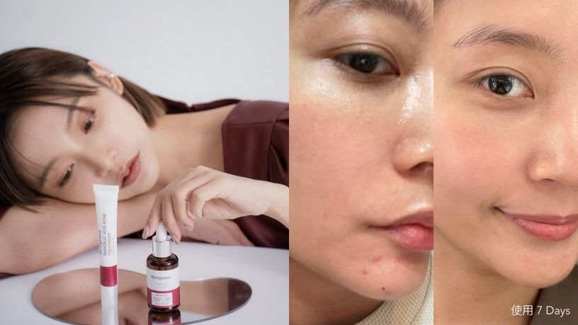 Neogence 霓淨思 杏仁酸透亮煥膚精華 煥膚小紅瓶 新一代無痛煥膚權威 杏仁酸瞬效淨痘無瑕精華 24h極效對抗痘痘 精準改善油痘瑕疵