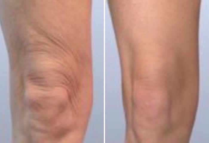 「肥膝蓋」顯腿胖又粗壯!教練3招瘦膝蓋周圍贅肉,堅持10天腿變直又細!