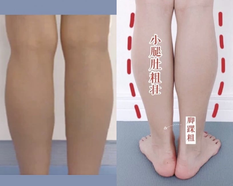 如何判斷小腿肌類型？水腫型小腿