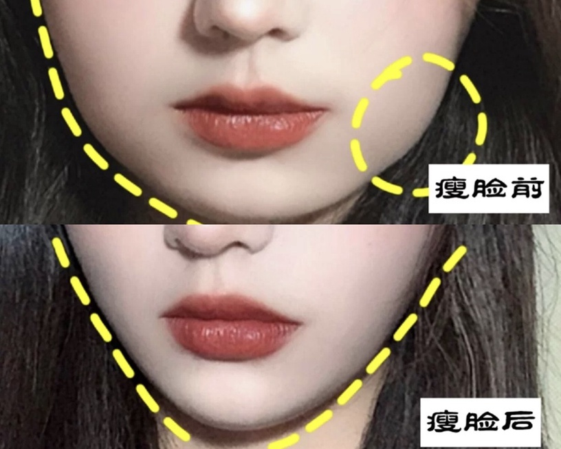 咬肌型臉