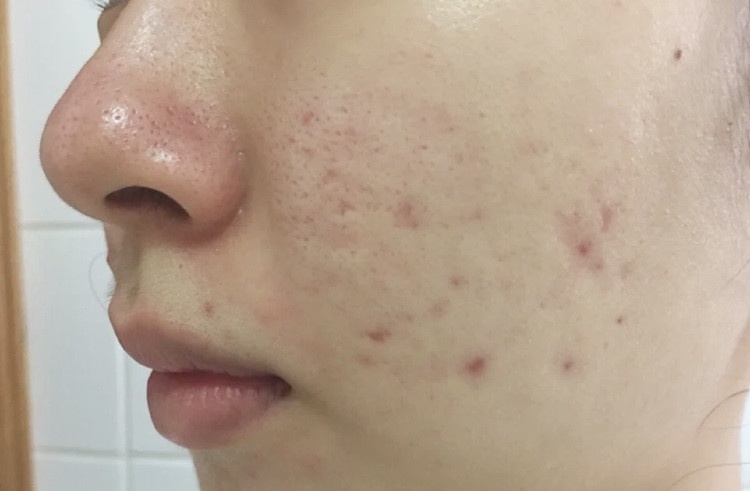 彩妝師瑕疵肌「無瑕輕薄底妝」畫法!脫皮/痘痘/毛孔都有解,新手底妝步驟這樣做