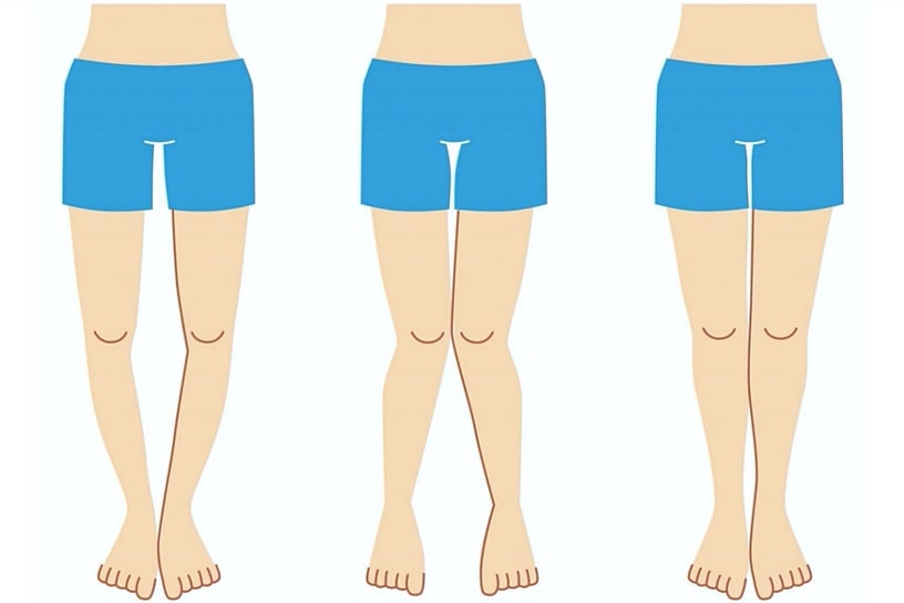 6個動作矯正腿型、瘦腿!O型腿、X型腿居家矯正運動,一個月有感縮臀、小腿變纖細