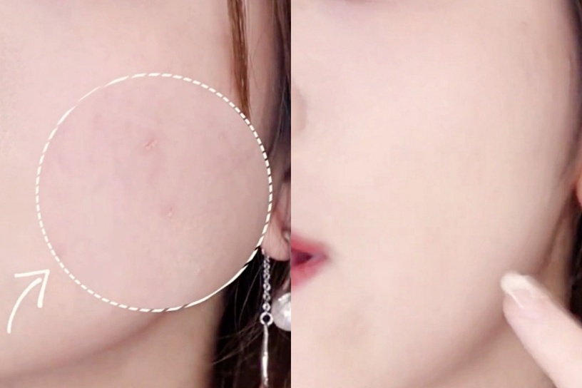 化妝師親授「眼影海綿棒」遮瑕技巧!3D腫痘、痘印馬上消失,遮瑕薄透自然、遮瑕度更高