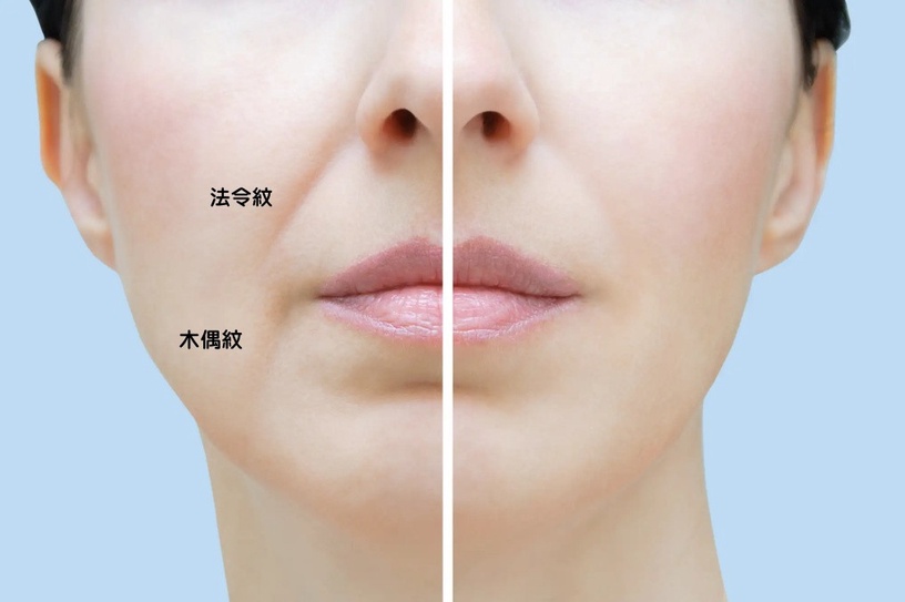 法令紋VS.木偶紋有什麼不同?
